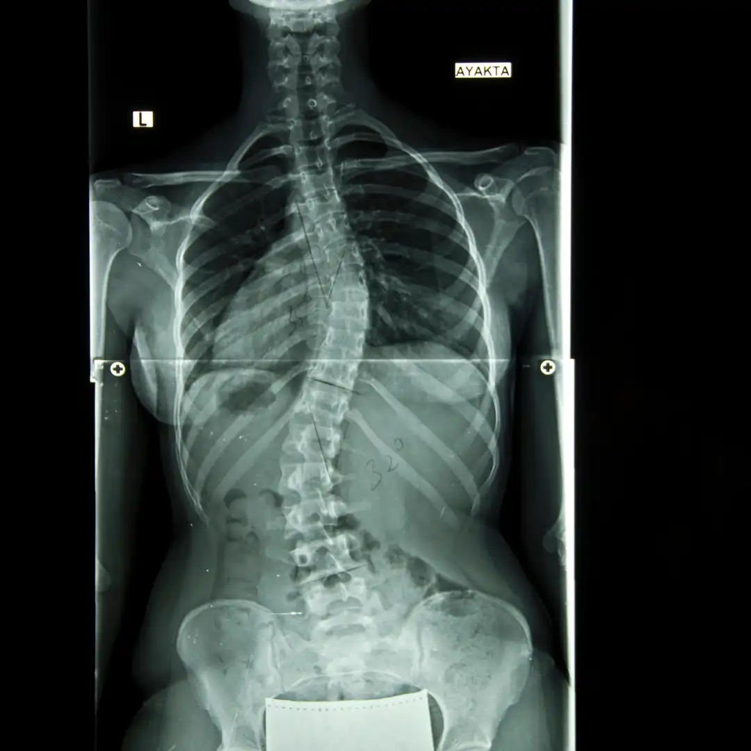 escoliosis leve adulto